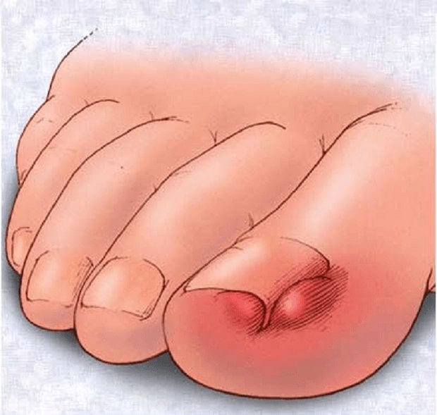 ingrown-toenail-1