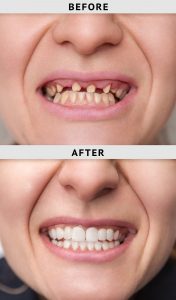 Restorative Dentistry at IMU Healthcarefor those who lose their teeth